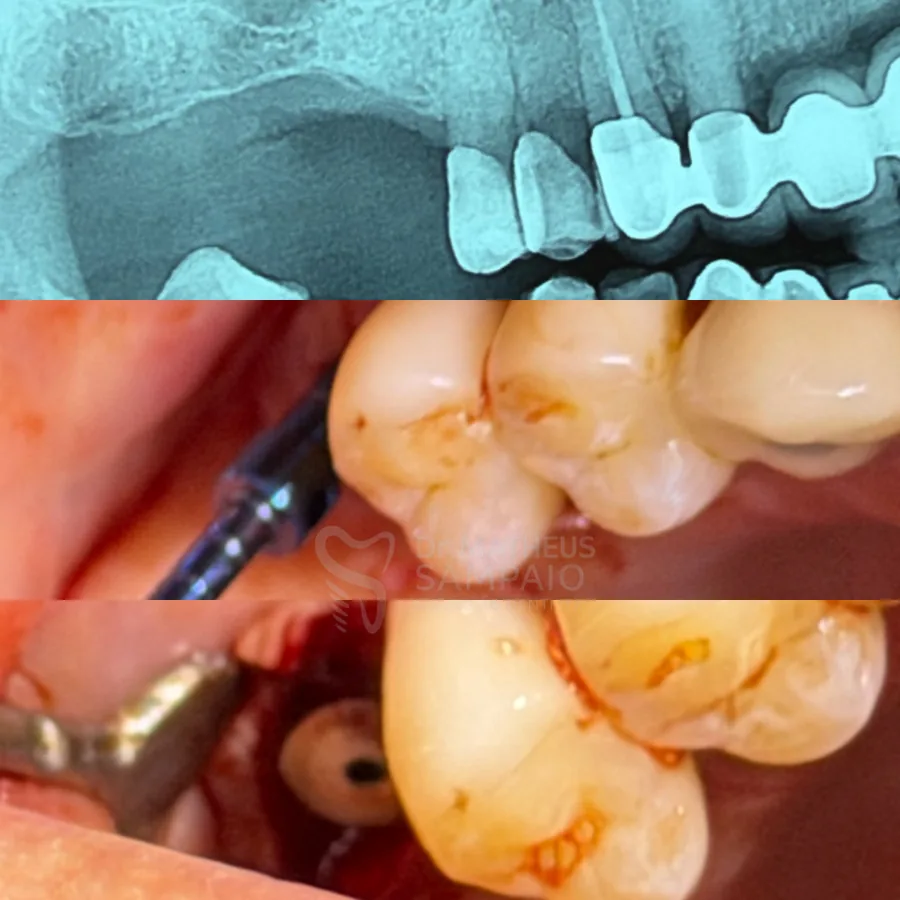 Implante: radiografia, instalação e cicatrizador