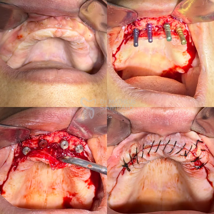 Instalação de quatro implantes em arcada, etapas da cirurgia
